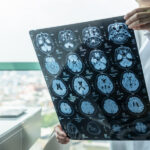 Brain Injury Claims